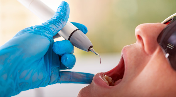 Paradontitisbehandlung rostock